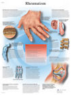 12-4618l Fabrication Enterprises Anatomical Chart Rheumatic Diseases Laminated 4053083005598