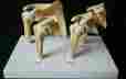 4-stage Osteoarthritis Oa Shoulder Gpi 1800