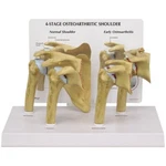 Gpi Anatomical #1800 4-STAGE Osteoarthritis Shoulder Anatomy Model. Fixed Price $99.95.