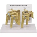 Shoulder Osteoarthritic 4-STAGE Gpi Anat Model Set LFA#1800 Make Offersee Video. Fixed Price $114.30.